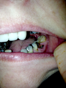 one side of my mouth